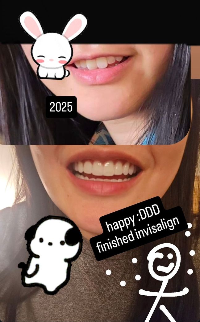 Before and after of Wing's teeth (Invisalign). The top picture shows bunny front incisors which were butterfly angled. The bottom shows perfect teeth after alignment, whitening and cosmetic bonding.